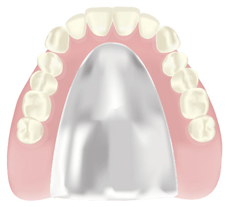 コバルトクロム床義歯