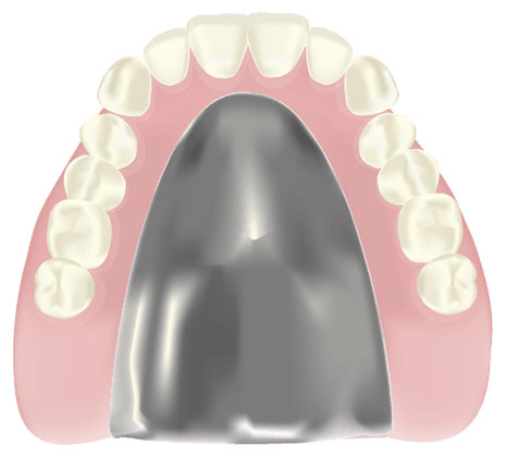チタン床義歯
